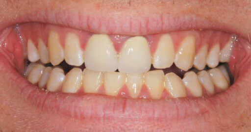 patient 2 teeth before