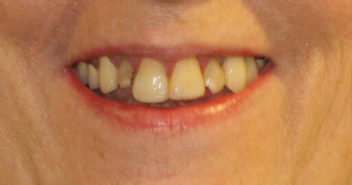 patient 4 teeth before